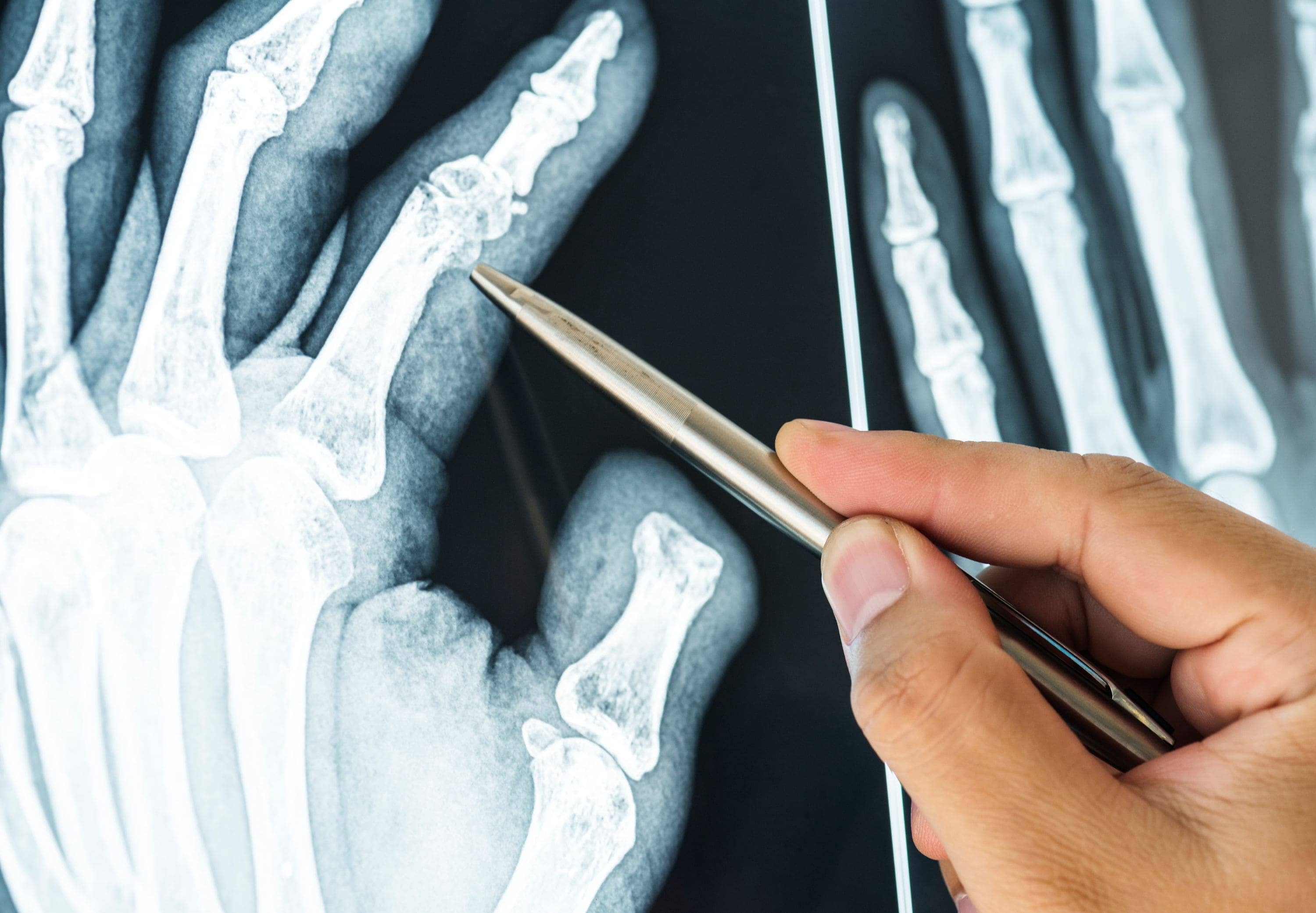 Tratamiento de fracturas en adultos en Cuautitlán Izcalli